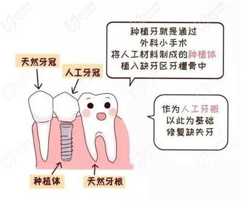 苏州种牙哪里好?美奥/美莱/美呀口腔种植牙技术好又便宜,牙齿对比照片-8682赴韩整形网