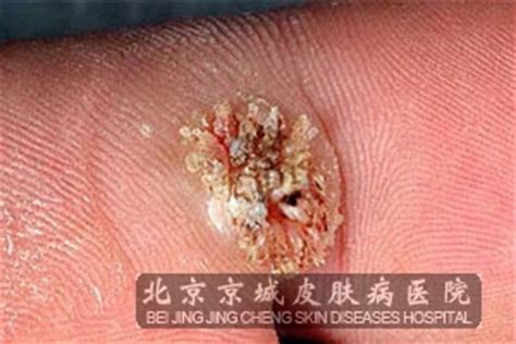 治疗寻常疣的措施都有什么_寻常疣_北京京城皮肤医院(北京医保定点机构)