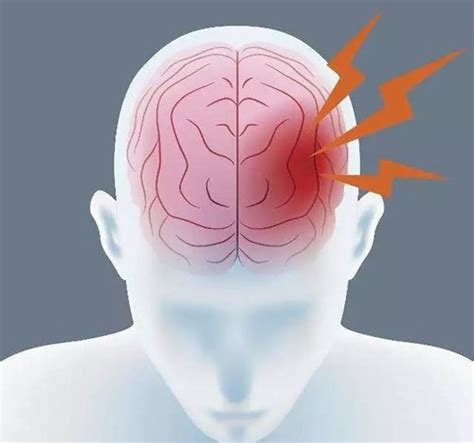 脑出血的成因、发病征兆和预防 - 知乎