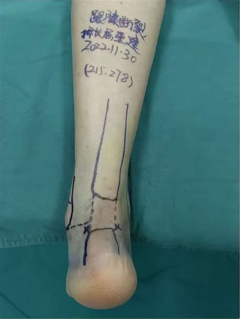 二一五医院开展首例踝关节镜下清理踇长屈肌腱转位跟腱功能重建术