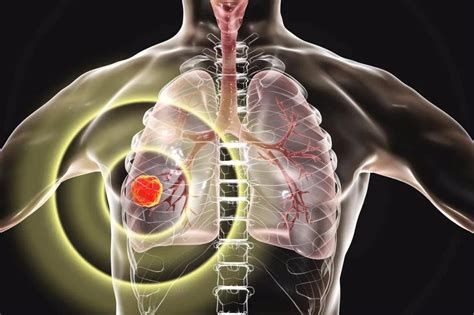一文看懂肺癌的分类、病症和治疗方案 - 知乎