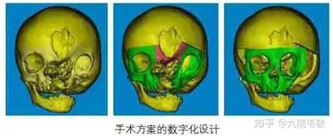 图22 新生儿颅骨(上面观)-人体解剖-医学
