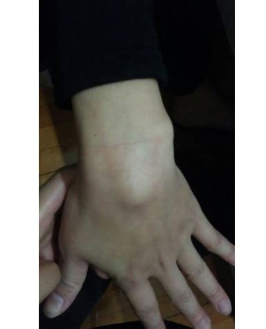 手背腱鞘囊肿图片
