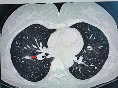一文总结肺不张的影像学表现丨以影识病_肺不张_影像学_医脉通