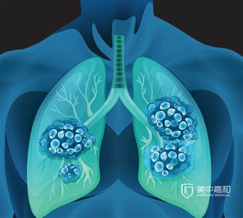 癌细胞转移到全身肺癌晚期有什么症状-康安途海外医疗
