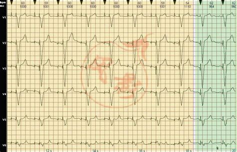 超简单的心电图教程，学会了一生受益！|心电图|QRS|教程|心率|-健康界