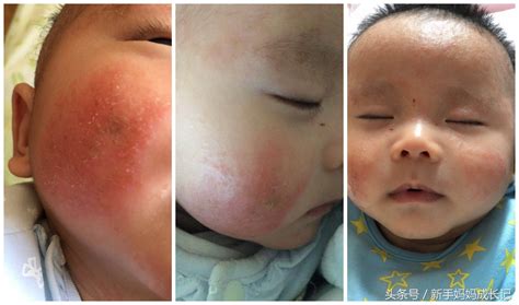 婴儿轻度湿疹图片大全（自家宝宝湿疹图片详解婴儿湿疹的症状和特点）-幼儿百科-魔术铺