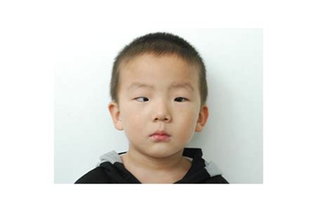 什么是斗鸡眼图片