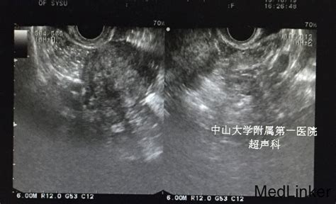 子宫内膜息肉做什么检查-中国医药信息查询平台