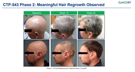 80%的头发可再生 超过40%的患者JAK抑制剂3期临床结果积极-试药员招聘与临床试验信息平台
