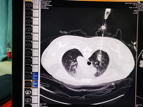 肺结节是怎么长出来的？医生教你看CT片，有2种可能是肺癌
