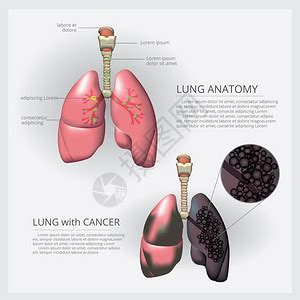 肺结节是怎么长出来的？医生教你看CT片，有2种可能是肺癌