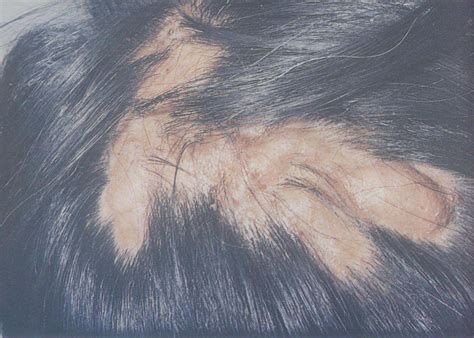 头部脓肿性穿掘性毛囊周围炎-临床实用皮肤病性病图谱-医学