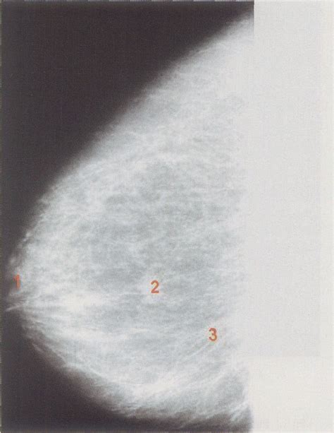 图3-34 乳房侧位X线像-基础医学-医学