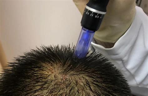 严重脱发是什么原因，怎么治疗严重脱发 – 生发垂直网