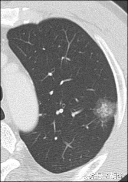 Cell | 迄今最全面的肺鳞状细胞癌蛋白质组图谱，揭示多个潜在治疗靶点 – SEQ.CN