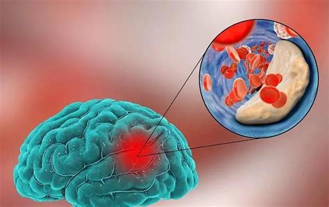 干细胞治疗中风（脑卒中）后遗症临床研究进展-杭吉干细胞科技