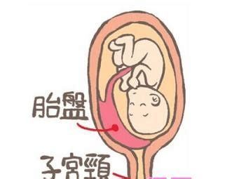 胎盘增厚，是代表着胎盘早剥了吗？|胎盘早剥|增厚|代表|胎儿|医生|非均质性|-健康界