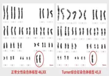染色体核型分析在染色体病诊断中的应用