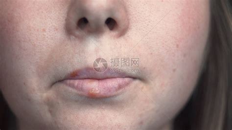 唇疱疹图片