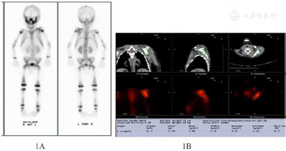儿童骨骼照妖镜——核素全身骨显像 - 中国核技术网