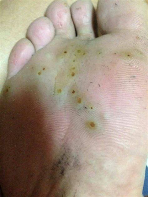 脚底发黑图片
