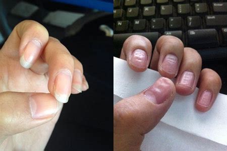 本人，女，24岁，最近突然发现我的手指甲和手指肉有分离的现象，但是又不痛不痒的，有点像烂的感觉。_百度知道