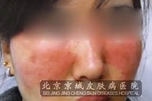 引发皮肤过敏的原因是什么_过敏_北京京城皮肤医院(北京医保定点机构)