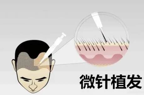 如何让头发再生的方法:南京友谊AAPE头发细胞再生疗法_南京医科大学友谊医院植发中心植发案例 - 毛毛网