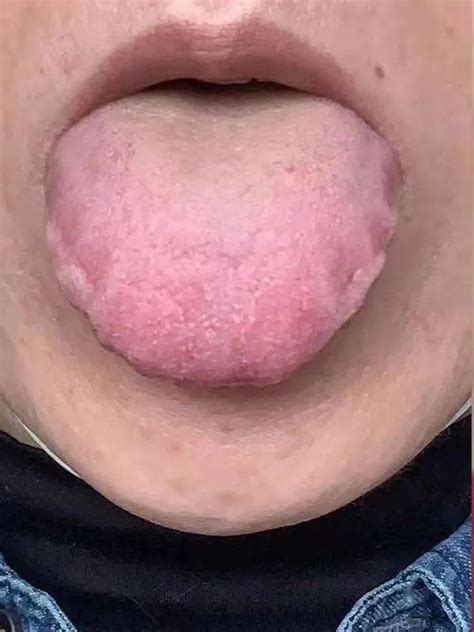 湿热舌头症状图片