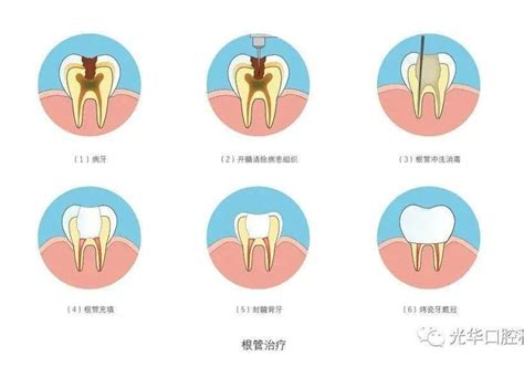 根管治疗及治疗后的注意事项_牙齿