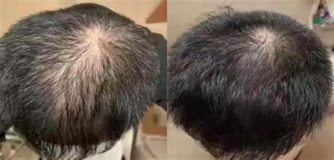 男子秃顶后求医无效，停用洗发水半个月竟长出新发，这有可能吗？ - 知乎