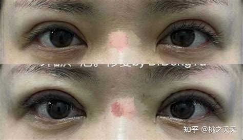 求问中国最好的双眼皮修复医生是谁，大师级的? - 知乎