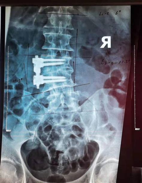 全球首例混合现实（MR）导航脊柱手术在深获成功_读特新闻客户端