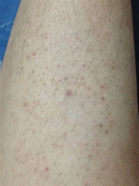两条小腿上有许多小红点，大腿内侧也有一些，不痛不痒。有好多年_毛囊炎_邻医网