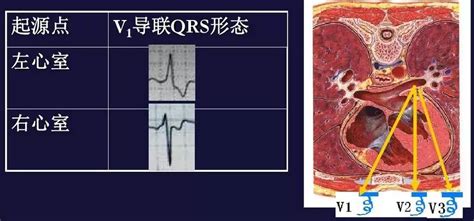 心电图图例分析：心房颤动、不完全性右束支阻滞、间歇性完全性右束支阻滞 - 爱爱医医学网