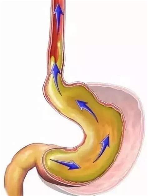 胃食管反流病的发病机制是什么？怎么检测？ - 孚维尔生物医疗