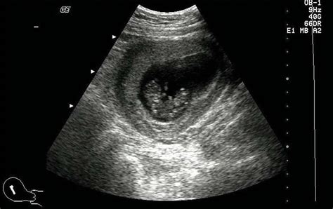 病例3 早期单绒毛膜单羊膜囊双胎妊娠-妇产科学-医学