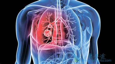 肺癌还能活多久？积极的治疗肺癌是非常关键的-康安途海外医疗