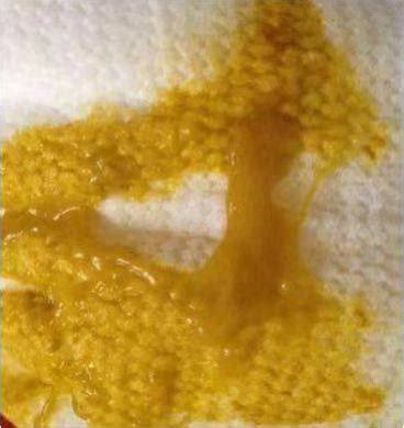 果酱样大便图片