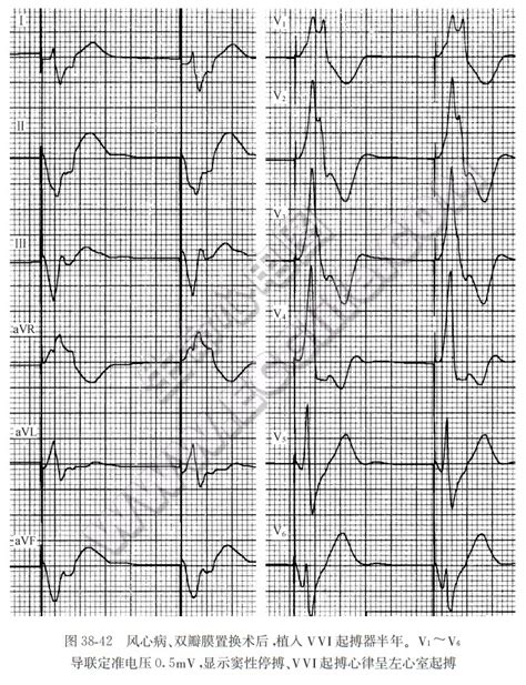第五节 AAI起搏-心律失常心电图-医学