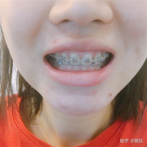 前牙即刻种植---过敏体质-高宁的博客-KQ88口腔博客