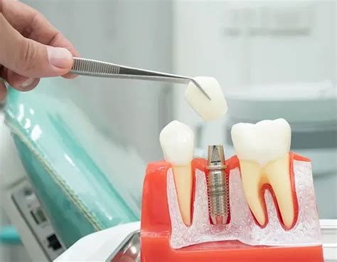 牙缺失寿命平均少活10到20年，老年人该如何选择种植牙 - 爱美容研社