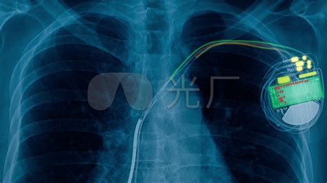 心脏起搏器迎来新时代，植入心脏起搏器（CRTD）后依然能做核磁共振 - 科室动态 - 湘南学院附属医院