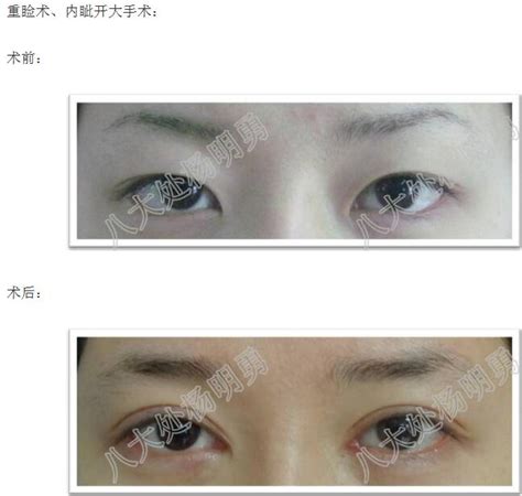 北京八大处整形杨明勇:双眼皮手术的需要_互联网_艾瑞网