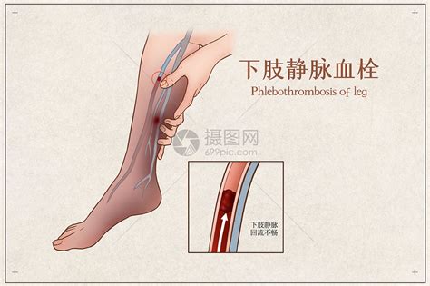 下肢静脉血栓图片