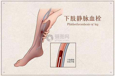 深静脉血栓科普系列一_浙江海创医疗器械有限公司