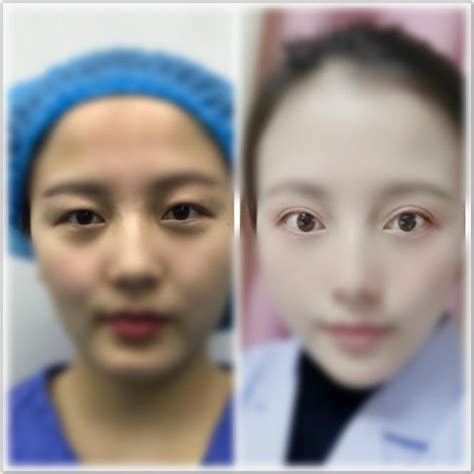 郑州做双眼皮修复出名的医生,坐诊郑州排行好的5家医院中,眼部失败手术修复-8682赴韩整形网