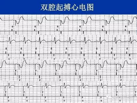 心电图图例分析：心房起搏心律AAI模式 - 爱爱医医学网