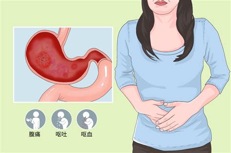 急性胃黏膜病变